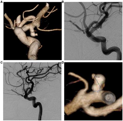 A predictive model for the recurrence of intracranial aneurysms following coil embolization